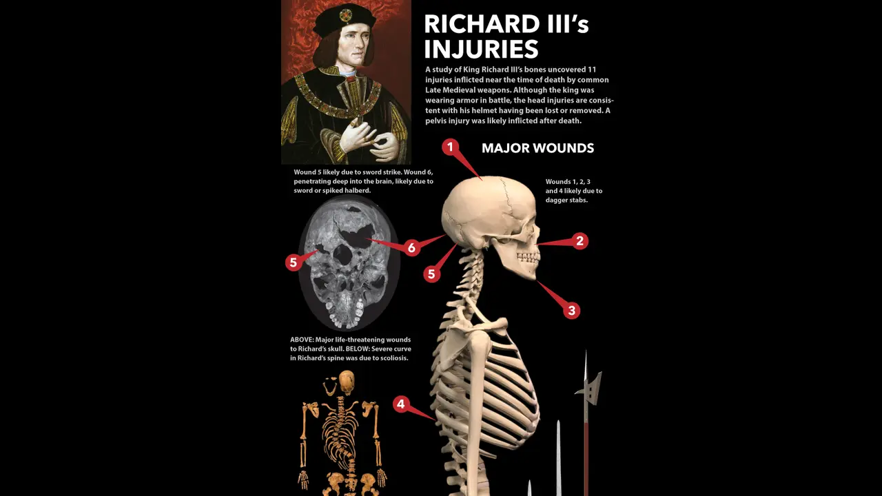 Cedera pada Kerangka Raja Inggris Richard III