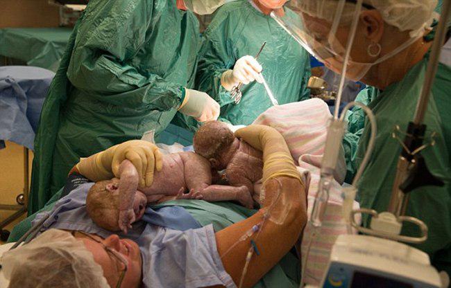Gerri mengeluarkan sendiri bayi kembarnya saat operasi caesar | foto: copyright dailymail.co.uk
