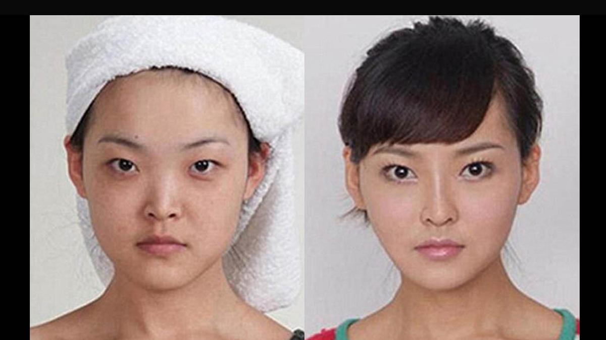 пластика разреза глаза фото до и после