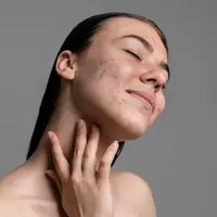 Perawatan kulit wajah dalam kondisi berjerawat./Freepik