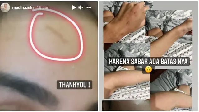 Diduga Alami KDRT oleh Suami, Ini 4 Fakta yang Dibongkar Medina Zein