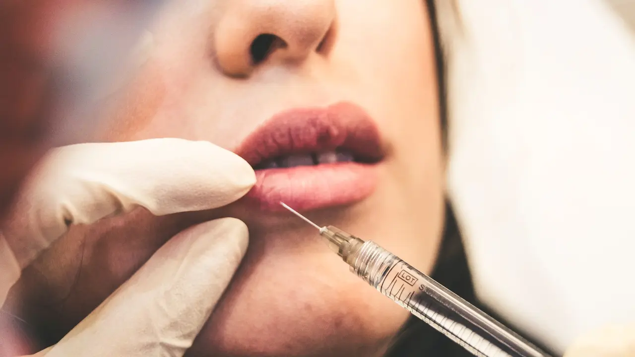 Ilustrasi Lip Filler