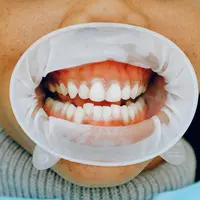 Ilustrasi gusi bengkak/Copyright pexels/Anna Shvets