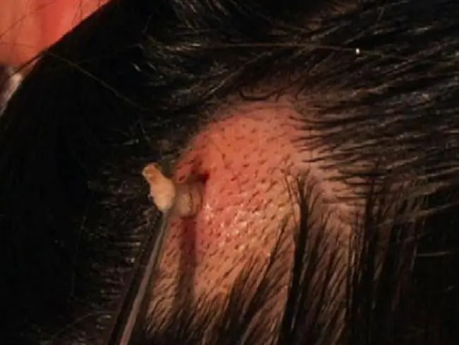Larva di kulit kepala