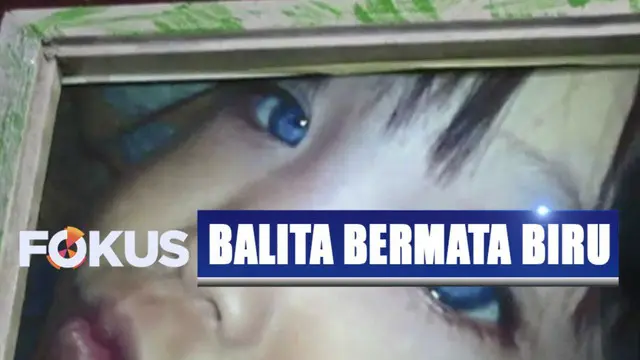 Langka, Bola Mata Bocah di Bandung Bisa Berubah-ubah dalam 4 Warna