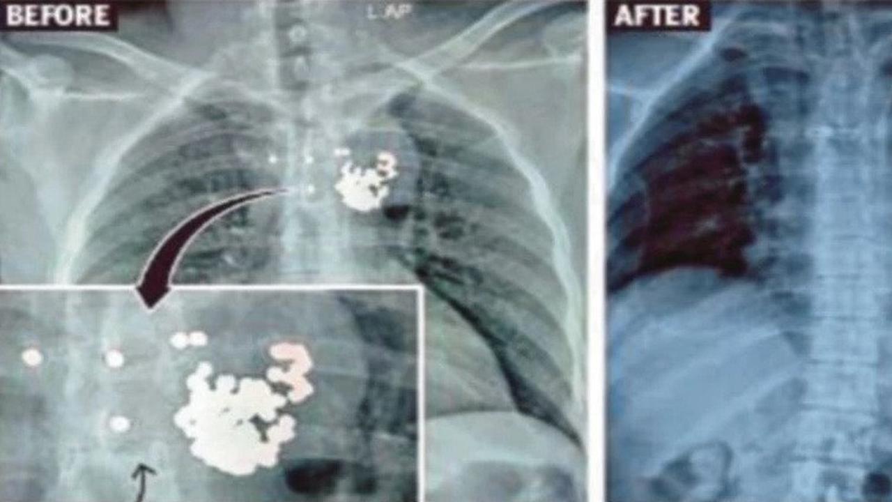 4 Tahun Hidup dengan 97 Peluru, Pria Ini Akhirnya Dioperasi