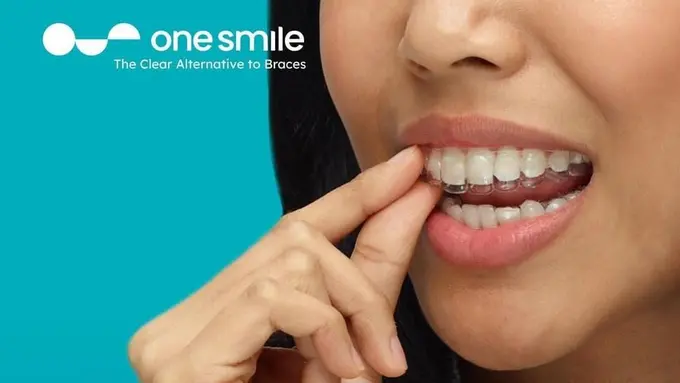 clear aligners
