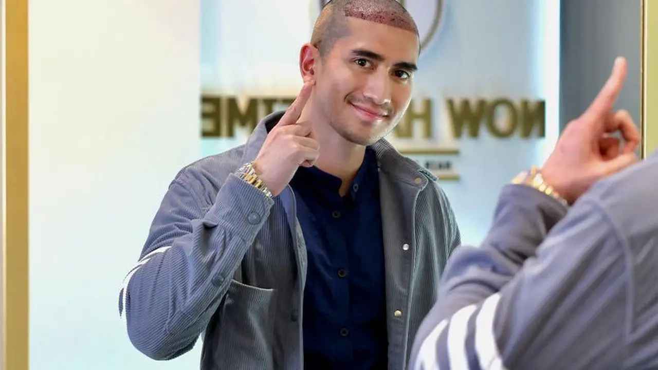 Verrell Bramasta lakukan Hair Transplant