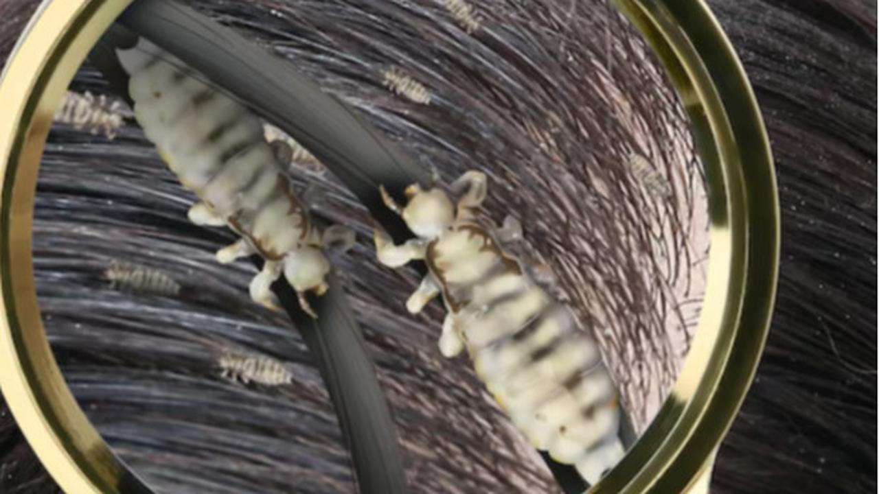 Say Goodbye to Kutu Rambut: Mengatasi Kutu Rambut dalam 5 Langkah