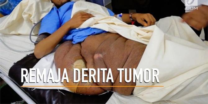 VIDEO: Tumor 20 Kg di Kaki Remaja Pakistan