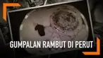 Seorang bocah 8 tahun di China mempunyai kebiasaan aneh, yakni memakan rambut. Akibatnya, gumpalan rambut seberat 1,5 Kg bersarang di dalam perutnya.