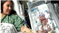 Sekitar selusin dokter dan perawat membantu proses kelahiran prematur, dari bayi kembar 5 tersebut melalui operasi sesar.