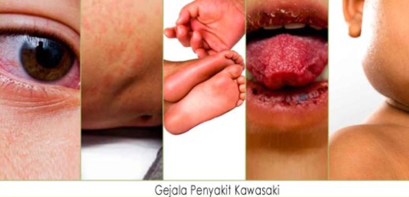 Penyakit langka ini dapat berisiko kerusakan jantung pada anak.