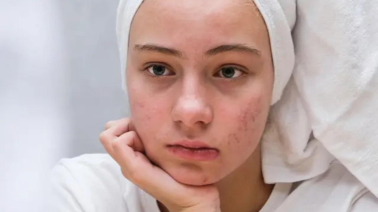 Ini Bedanya Muka Berminyak dan Muka Lembap, Jangan Salah Rawat