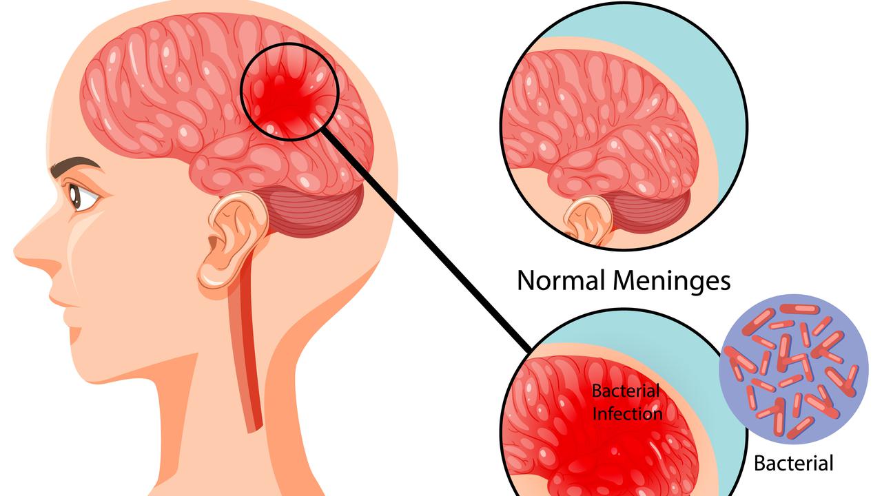 Ilustrasi Meningitis