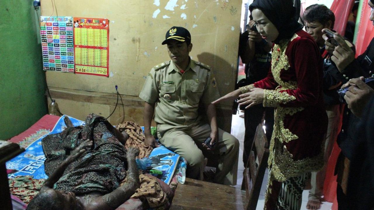 Kulit Melepuh Sekujur Tubuh, Kasturi Diduga Akibat Alergi Obat