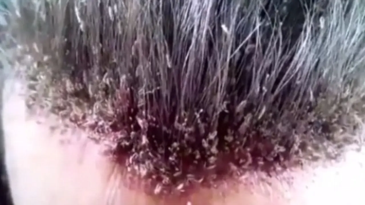 Menjijikkan, Kutu Rambut Terbanyak Ada di Kepala Pria Ini