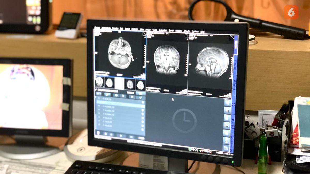 Cek Biaya Brain Check Up di RSPON, Tes Tercanggih Mengecek Kondisi Otak ...