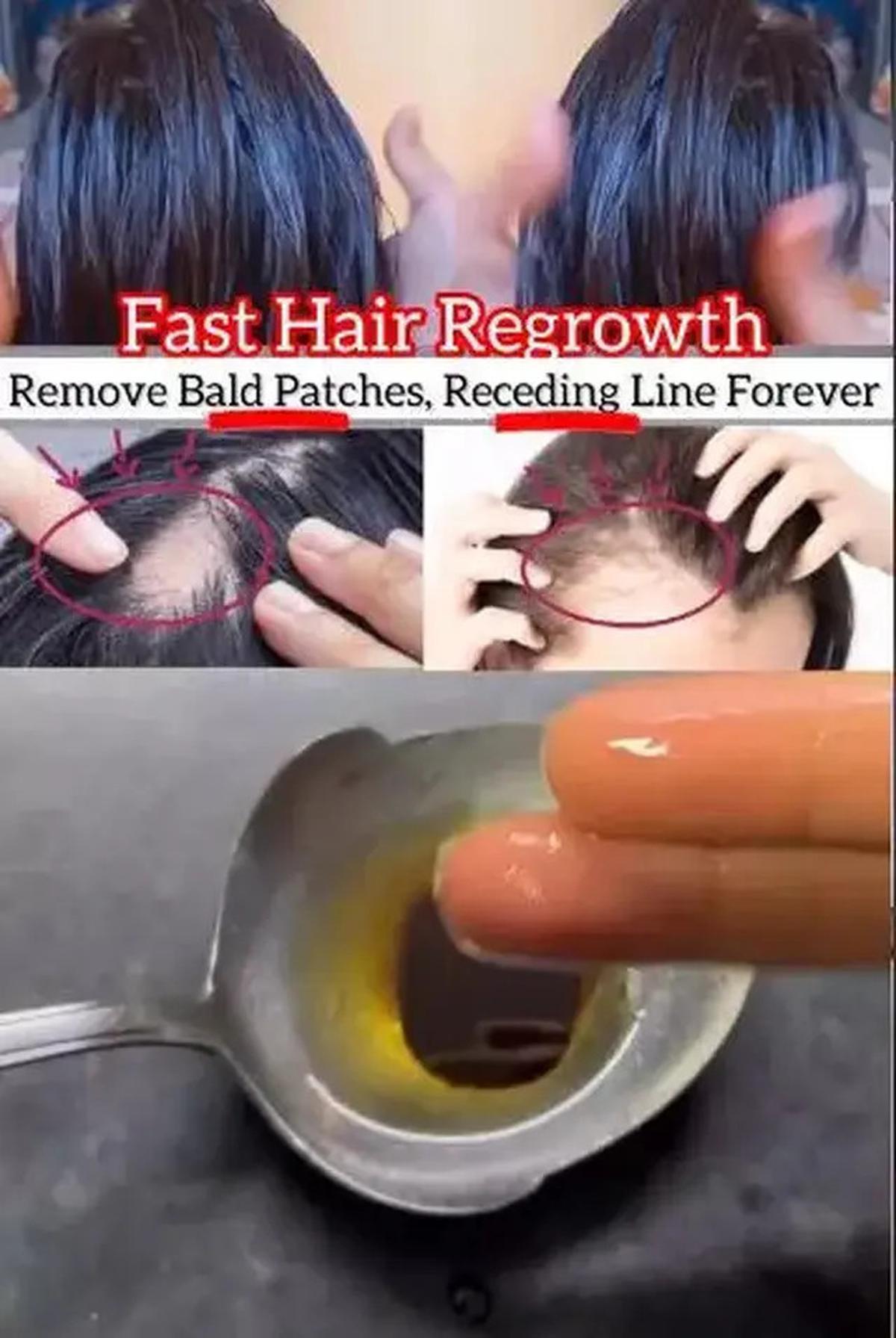 Cara Ampuh Mengatasi Rambut Botak di Area Dahi, Cukup dengan 2 Jenis Minyak