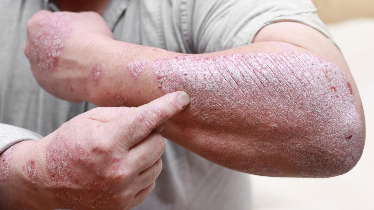 Psoriasis