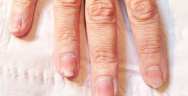 Reaksi yang terjadi karena zat berbahaya dalam proses manicure | foto: copyright dailymail.co.uk