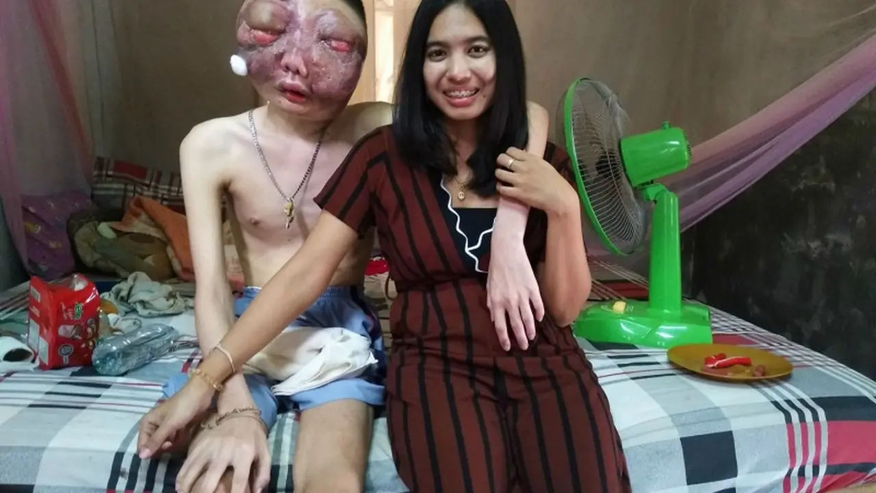 Bukti Cinta Sejati, Kanker Mata Sang Kekasih Tak Goyahkan Hati Wanita Ini