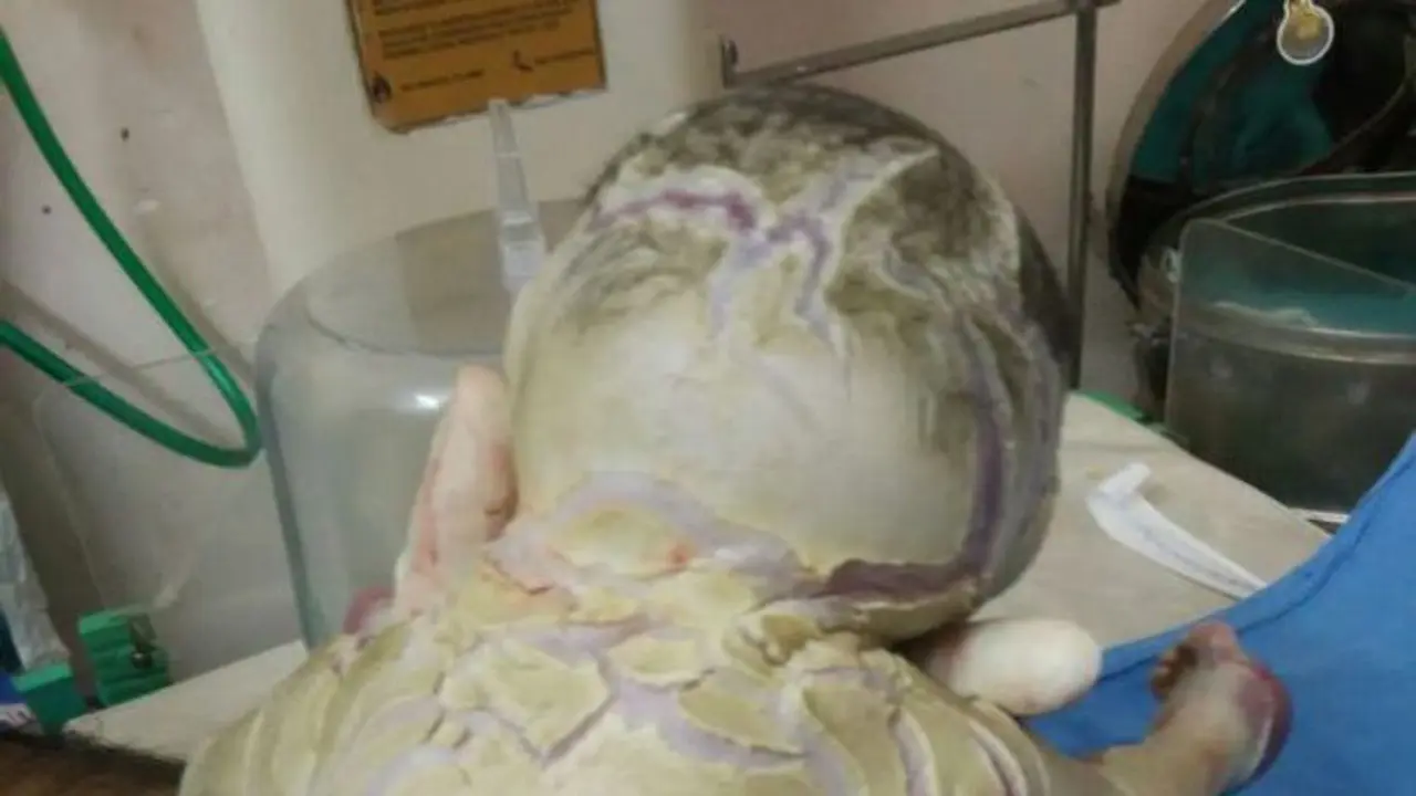 Bayi tanpa kulit