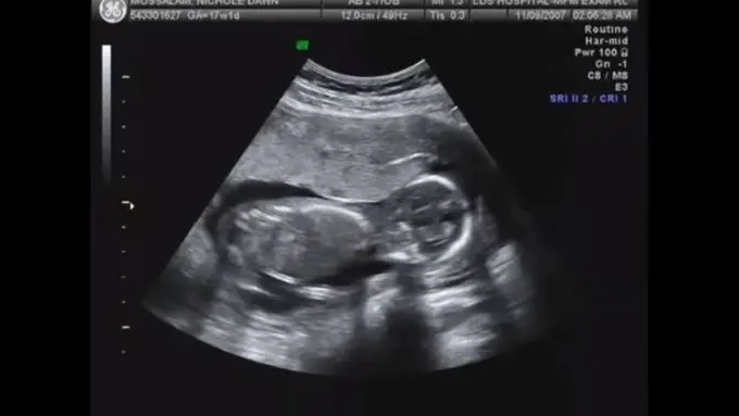 Bayi Bersujud Dalam Rahim Saat Dibacakan Alquran