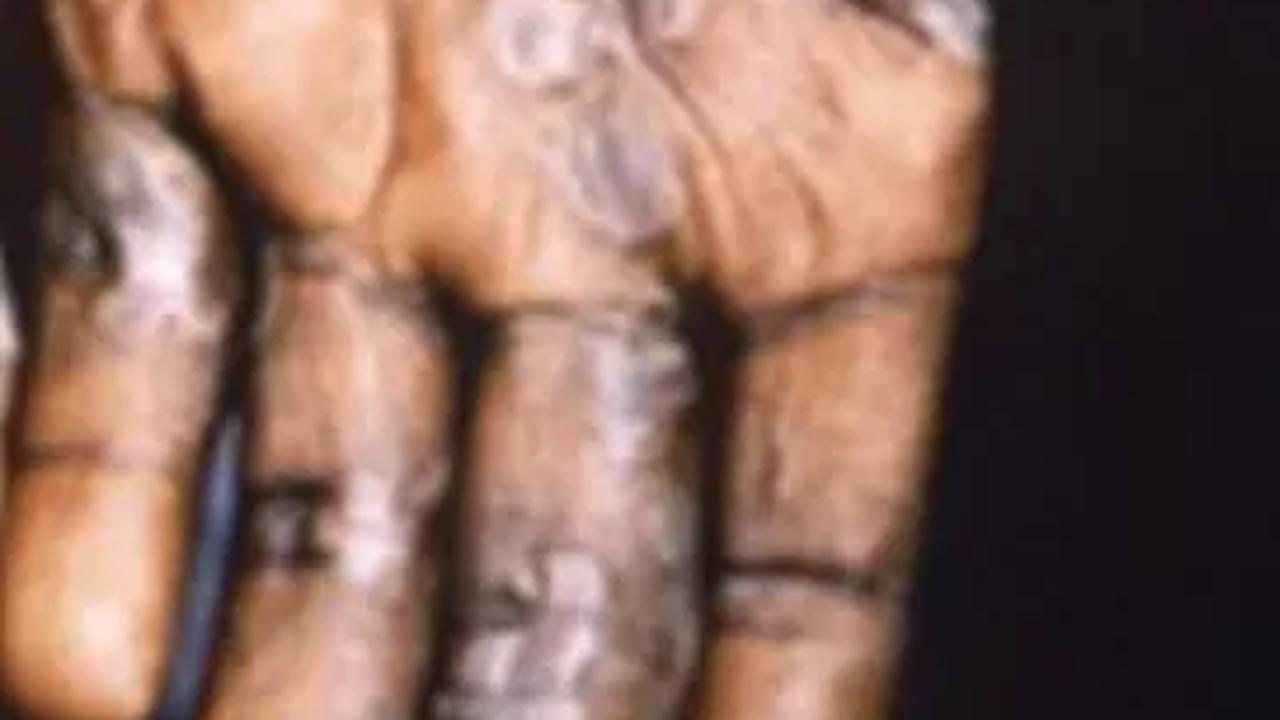 Kasus Cacar Monyet Meningkat, Kemenkes Sebut Mayoritas Pasien Punya Orientasi Biseksual
