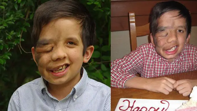 Foto: copyright Facebook/Living with Neurofibromatosis