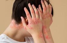 Jangan Sepelekan Alergi Pada Anak! Ini Gejala, Penyebab Serta Pengobatannya