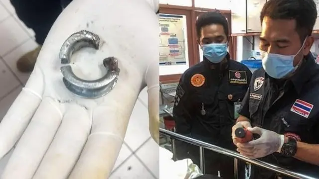 Demi Perbesar Mr P, Pria Ini Nekat Pasang Cincin Baja di Alat Kelamin