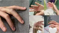 Ular Sanca Gigit Paha dan Jari Gadis Ini saat Buang Air, Darah Bercucuran