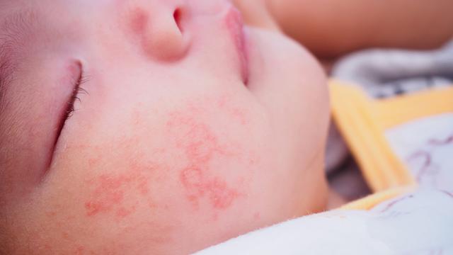 Fakta Seputar Dermatitis Atopik