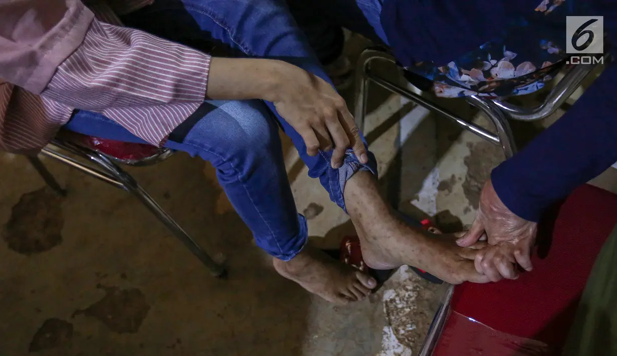 Warga sedang diperiksa kulit bagian kaki di komplek Rusunawa Muara Baru, Jakarta, Selasa (14/5/2019). Pemeriksaan kulit secara cuma-cuma merupakan program Vaseline Healing Project yang bertujuan meningkatkan perilaku hidup bersih dan sehat. (Liputan6.com/Fery Pradolo)