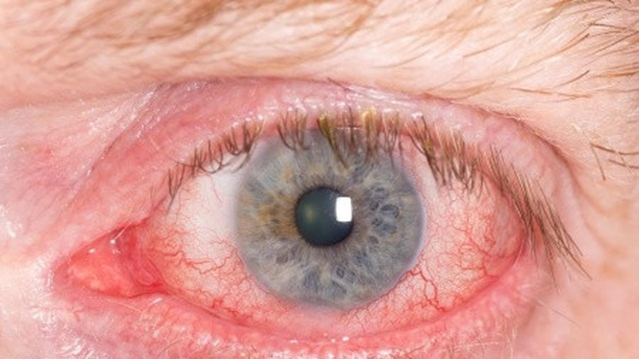 12 Penyebab Mata Merah Perih yang Sering Terjadi dan Cara Mengatasinya