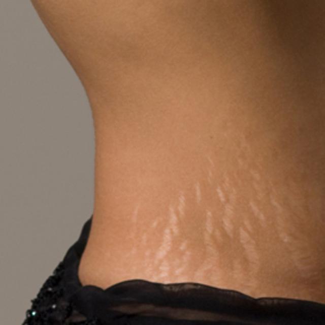 Ketahui 5 Fakta Tentang Strech Mark Health Liputan6 Com