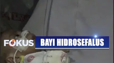 Bayi 8 bulan penderita hidrosefalus, infeksi paru-paru, dan gizi buruk, harus tergolek tanpa perawatan dokter karena tak punya biaya berobat.