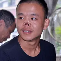 Setelah sekian lama hidup tanpa hidung, pria ini melakukan operasi plastik untuk memilikinya.