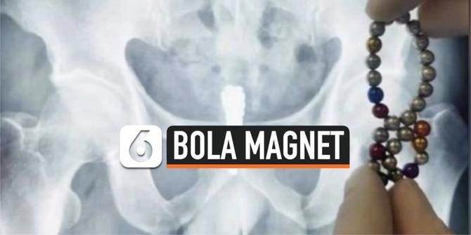 VIDEO: Dokter Temukan 28 Bola Magnet Dalam Kandung Kemih Pria