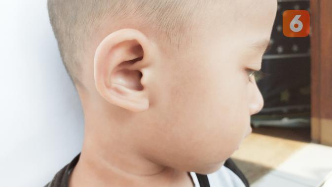 Mengenal Microtia Gangguan  Pada Telinga  yang Bisa 