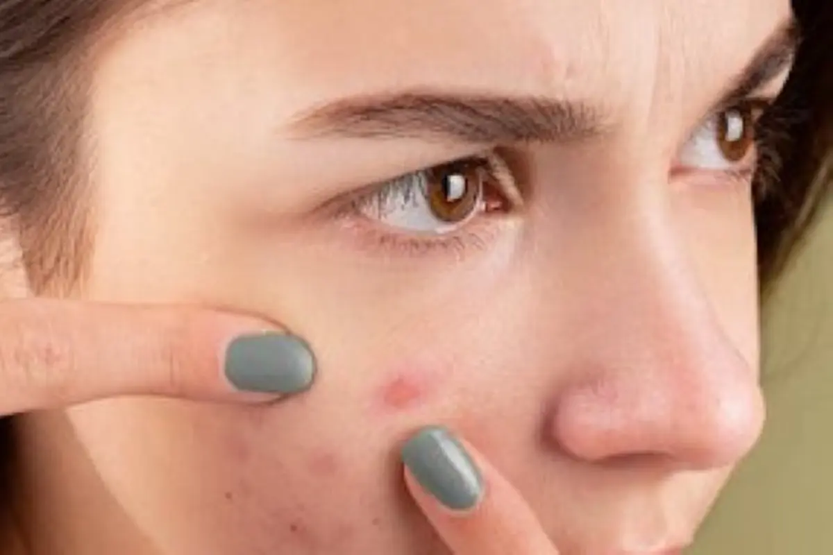 acne 1