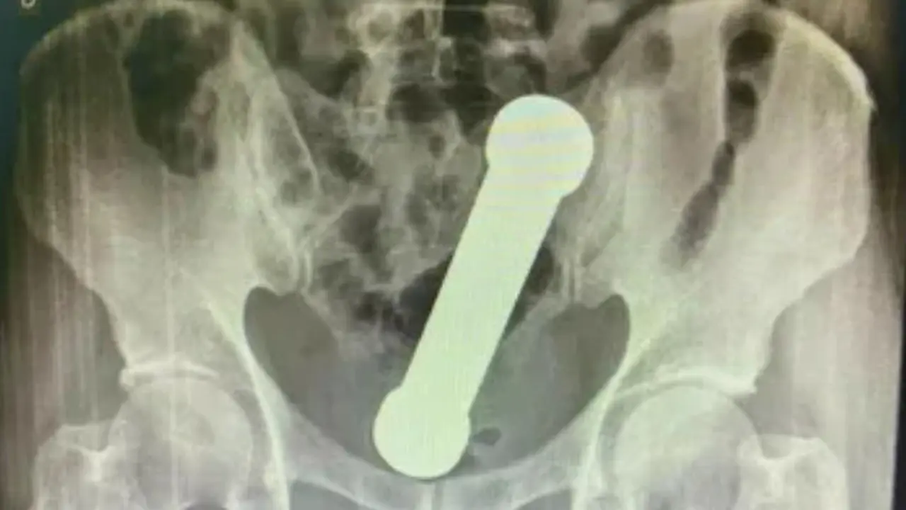 Enggak Habis Pikir, Dumbbell 2kg Tersangkut di Anus Pria Ini