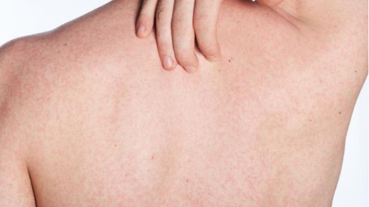 Hilangkan Panu dengan Mudah, 8 Bahan Alami yang Perlu Anda Ketahui