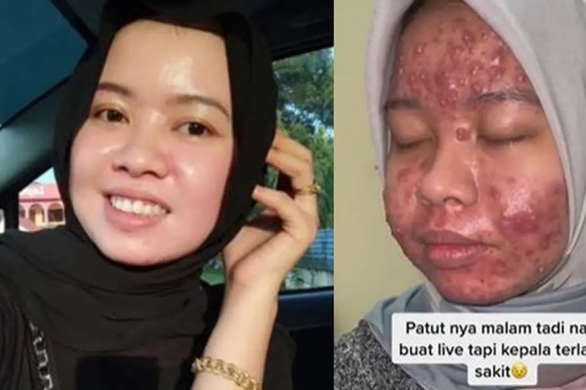 Sempat Disangka Terkena Guna-Guna, Wajah Wanita Ini Berubah Jerawatan Parah