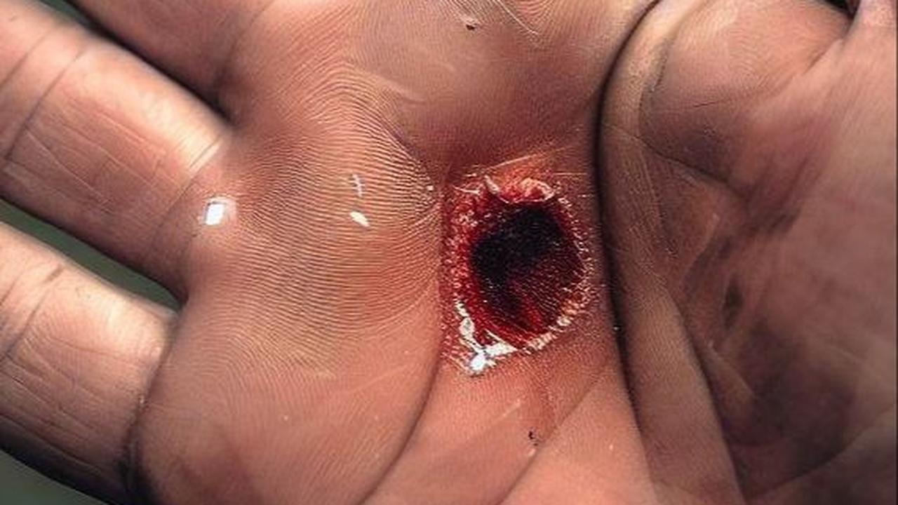 Bisa Masuk Tubuh Manusia Melalui 4 Cara, Ketahui Gejala Terinfeksi Antraks