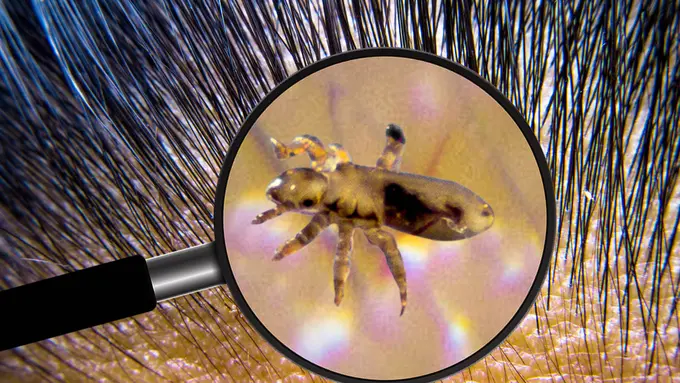 Nggak Perlu Khawatir, Inilah 3 Cara Menghilangkan Kutu Rambut dengan Bahan Alami