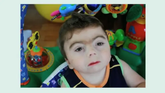 Sindrom Cornelia de Lange. Tangkapan layar (youtube.com/PaulBolin,M.D)