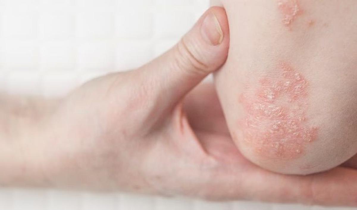 <b>2. Eksim atau dermatitis atopik</b>