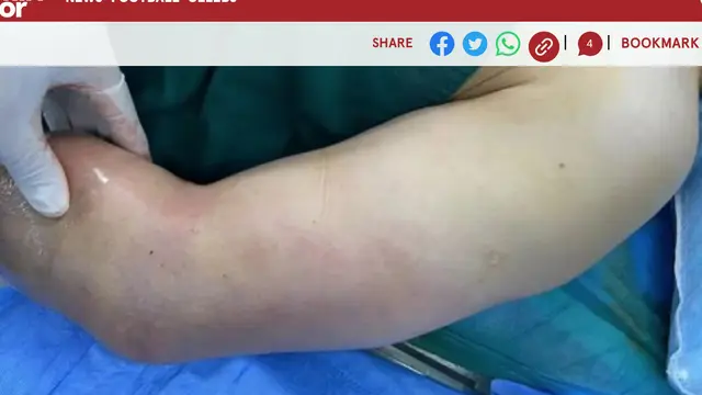 Gambar tangan yang terinfeksi bakteri